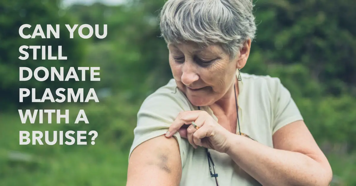 Can You Still Donate Plasma with A Bruise? Facts & Myths