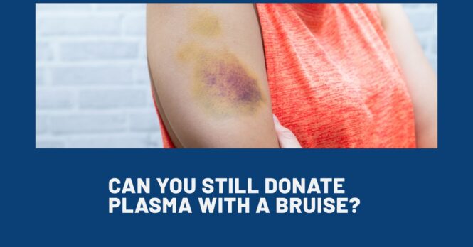 Can You Still Donate Plasma with A Bruise